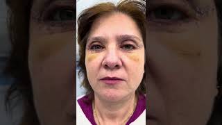 Blefaroplastie totală superioara  inferioară realizată de către Doctor Levy [upl. by Jinny299]