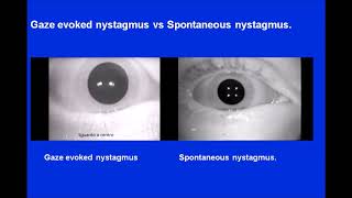 Gaze Nystagmus vs Spontaneous Nystagmus [upl. by Teplica]