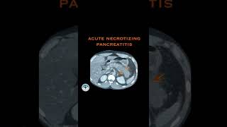 Acute necrotizing pancreatitis [upl. by Sergent974]