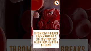 Thrombolysis Therapy Causing Breakdown of Blood Clots  Symbiosis Speciality Hospital [upl. by Oicul]