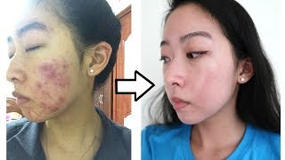 How I Cleared My Acne with ONE Product NO ACCUTANE [upl. by Skyler]