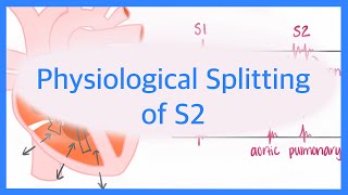 Physiological Splitting of S2 [upl. by Ennairac817]