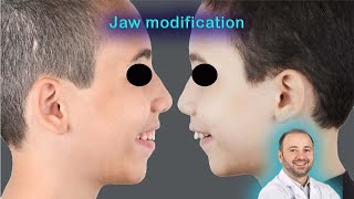 The importance of early correction of the jaw for kidsorthopedic ￼correction of the jawsno surgery [upl. by Accever]