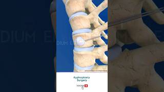 Spine Fracture Kyphoplasty ↪ 3D Medical Animation Shorts Kyphoplasty KyphoplastySurgery Spine [upl. by Swerdna]