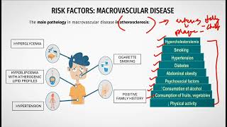 Macrovascular Complications Diabetes StrokeCVA CADPAD [upl. by Nnylacissej]