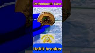 Orthodontic Cast  Nance appliance  Habit breaker [upl. by Vince]