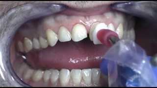 Prepless Veneers Procedure at Cosmetic Dental Associates San Antonio TX Dental Practice [upl. by Gracie]