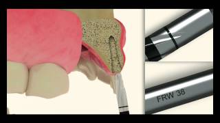 3D Animation  Dental Implant System [upl. by Atalie]