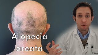 Alopecia areata qué debes hacer [upl. by Etat]