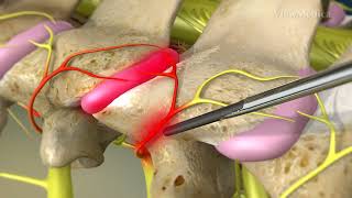 What is Cervical Facet Radiofrequency Neurotomy [upl. by Domeniga198]