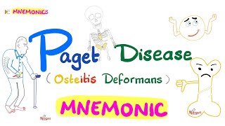 Paget Disease of Bone Osteitis Deformans  with a Mnemonic [upl. by Lamiv]