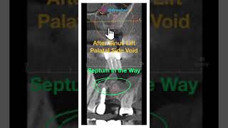 Vertical subantral Sinus Lift with Densah Burs after an Incomplete Lateral Wall Sinus Lift versah [upl. by Robbie]