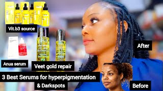 BEST FACE SERUMS FOR A GLOWING SKIN HOW TO CLEAR HYPERPIGMENTATION QUICKLY  FACE amp BODY TREATMENT [upl. by Stetson]