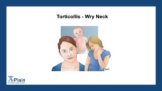 Torticollis  Wry Neck [upl. by Kado]