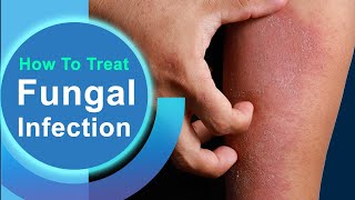 RINGWORM  Dr Pradeep Kumar  Dermatology amp STD Specialist  Aarogya [upl. by Arnulfo]