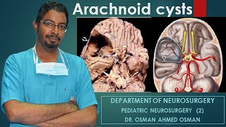 1 Arachnoid cysts Second Part [upl. by Adanama]