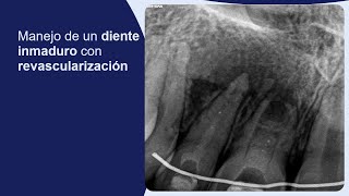 Manejo de un diente inmaduro con revascularización [upl. by Eamaj]