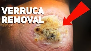 How to Get Rid of Plantar Warts at Home [upl. by Mcclain]