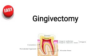 Gingivectomy [upl. by Ynnatirb]