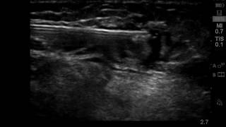 Ultrasound guided saphenous nerve block below knee joint [upl. by Aihtnys746]