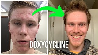 Taking Doxycycline for Acne [upl. by Enelhtak]