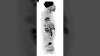 Sarcoidosis Symmetric bilateral hilar hypermetabolic lymphadenopathy [upl. by Maryjo]