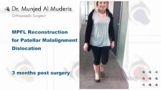 MPFL Reconstruction for Patellar Malalignment Dislocation  3 months post surgery [upl. by Redman]