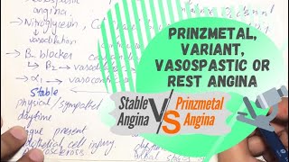 Prinzmetal Variant Vasospastic or Rest Angina  Stable VS Prinzmetal Angina [upl. by Irra]