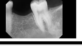 Idiopathic osteosclerosis on Pano and PA [upl. by Balas]