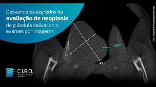 Avaliação de Neoplasia de Glândula salivar em exame por imagem [upl. by Moya442]