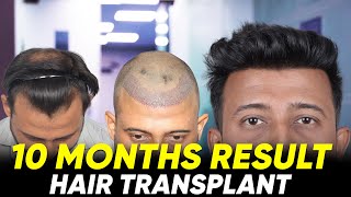 Hair Transplant in Kathmandu  Best Results amp Cost of Hair Transplant in Kathmandu [upl. by Aicylla433]