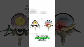 Qu est ce qu une hernie discale Decouvrez les causes et les symptomes [upl. by Carin]