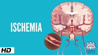 Ischemia Causes Signs and Symptoms Diagnosis and Treatment [upl. by Schriever]