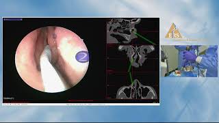 ERS London 2018 Andreas Leunig Frontal Sinus MasterClass Cadaveric Dissection [upl. by Chew]