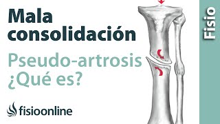 ¿Qué es la pseudoartrosis o mala consolidación de fracturas [upl. by Aible]