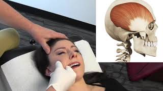 Temporal Headaches  Temporalis Muscle Internal Release Procedure  MSR Demo [upl. by Korff]