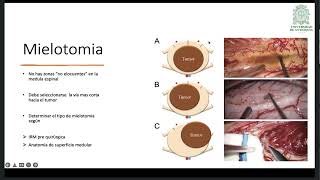 Técnica quirúrgica en astrocitoma medular [upl. by Janessa]