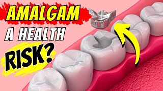 The Truth About Amalgam Fillings What You Need to Know [upl. by Fisher246]