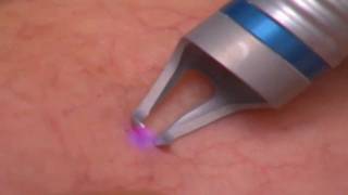 Laser Spider Vein Treatment at JVAI [upl. by Normy]