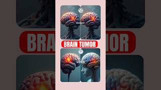 quotBrain Tumor Awareness Symptoms Diagnosis and Treatmentquot By OperationTheatreSKR BrainTumour [upl. by Leifer]