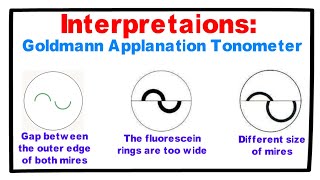 Interpretations Goldmann Applanation Tonometer [upl. by Nasaj]