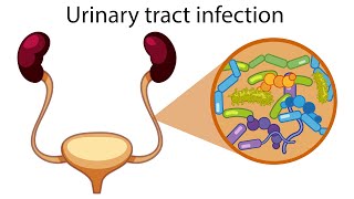 Urinary tract infection web embeddable [upl. by Ramon]