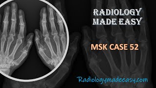 60 year old female with joint pain in both hands  FRCR Radiology MSK case 52 [upl. by Nalek]