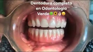 Dentadura Postiza Completa [upl. by Arretnahs]