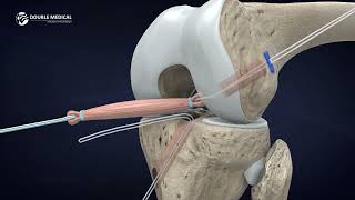 Anterior Cruciate Ligament ACL Reconstruction Surgery with Our Knee Reconstruction and Repair System [upl. by Sew690]