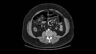 Infato intestinal com pneumatose [upl. by Sayed677]