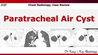 Paratracheal Air Cyst CT [upl. by Barnum362]