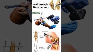 Arthroscopic Knee Surgery medical animation 3d short BiologywithAliya [upl. by Willamina167]