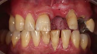 Endodontic treatment dental avulsion PRGF and temporary 3d printed bridge [upl. by Elletnahc]