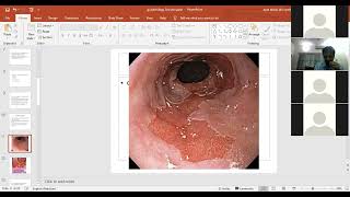 Gastrointestinal Pathology Clinical Representation  Esophagus Cancer  Stomach Disorders [upl. by Enyehc]